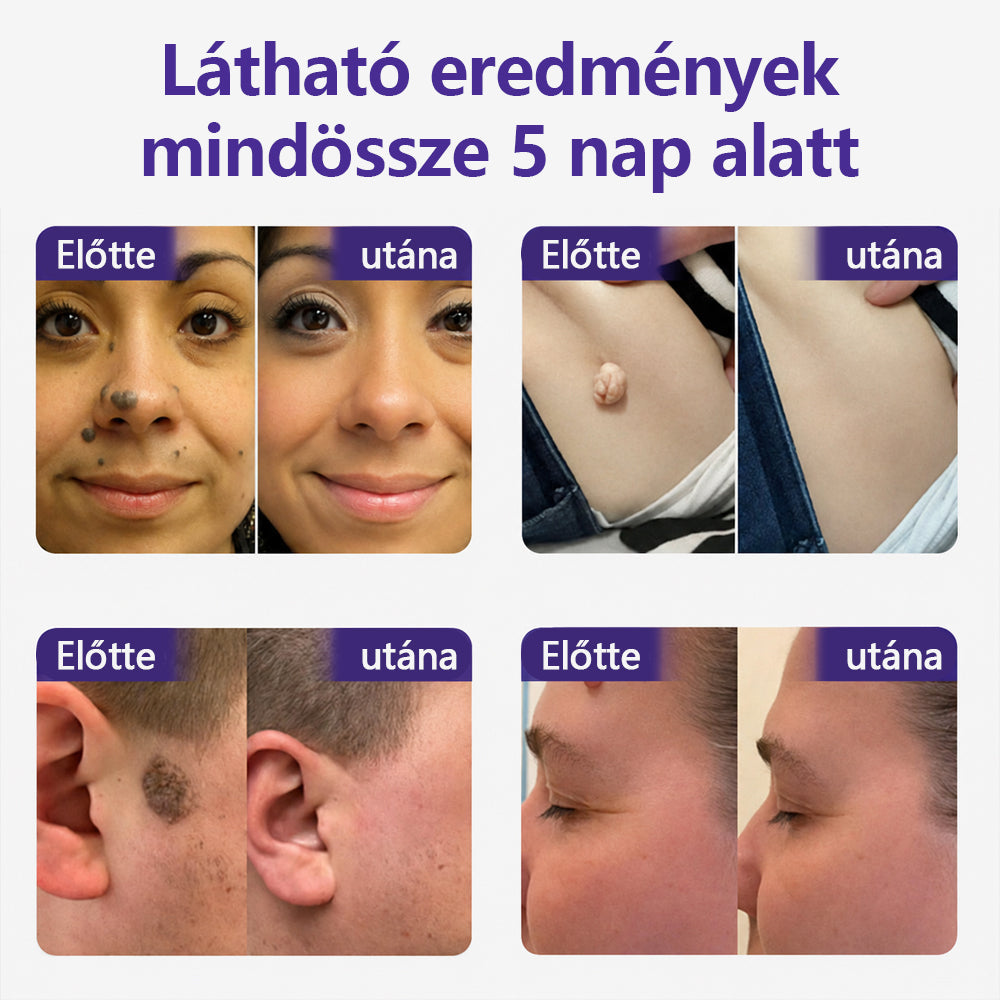 👩🏻‍⚕️COLTURE® szemölcs- és anyajegytávolító mikrotűs tapasz🎁
