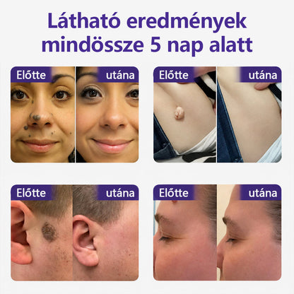 👩🏻‍⚕️COLTURE® szemölcs- és anyajegytávolító mikrotűs tapasz🎁