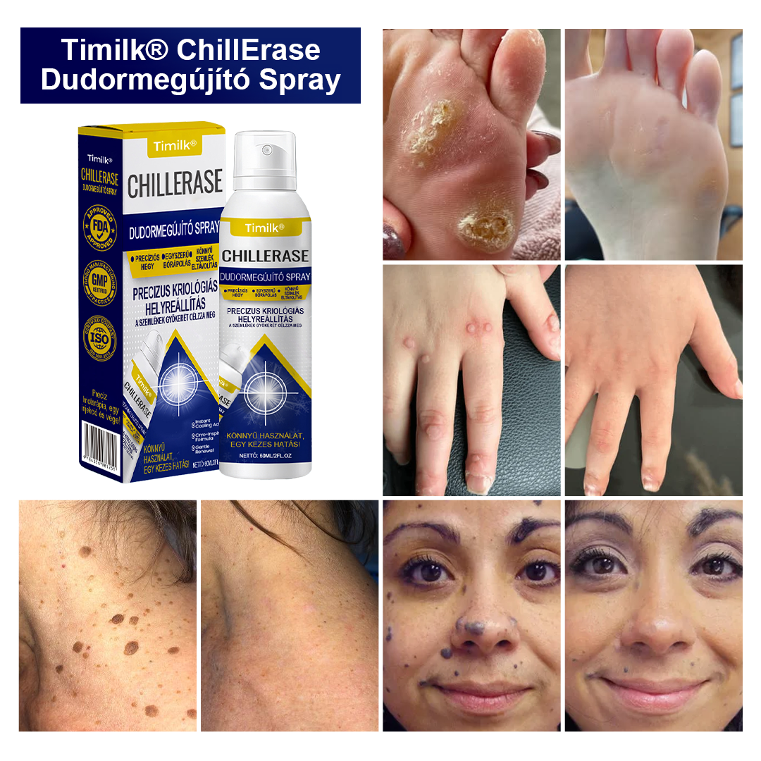 Timilk® ChillErase pattanásmegújító spray⭐️