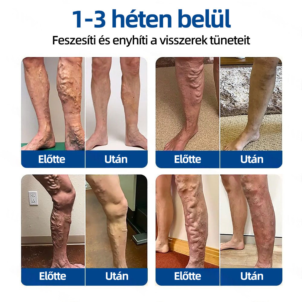 🇭🇺Yutuof® 👩‍⚕️VeinTarget mikrotűs tapasz⚡☑️Azonnali enyhülés hosszú távú eredmények⭐️