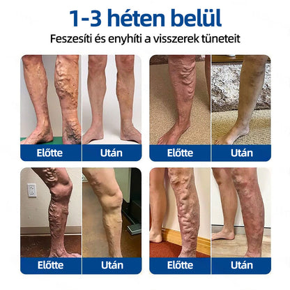🇭🇺Yutuof® 👩‍⚕️VeinTarget mikrotűs tapasz⚡☑️Azonnali enyhülés hosszú távú eredmények⭐️
