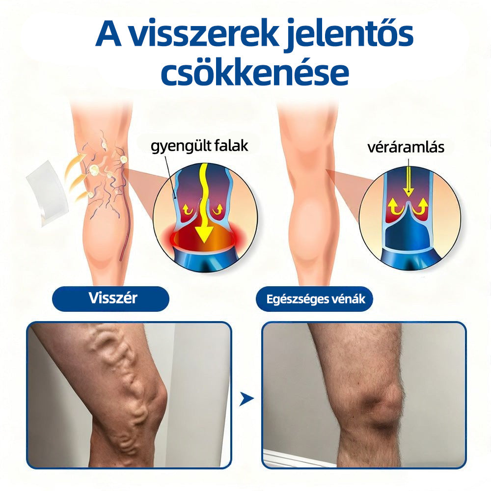 🇭🇺Yutuof® 👩‍⚕️VeinTarget mikrotűs tapasz⚡☑️Azonnali enyhülés hosszú távú eredmények⭐️