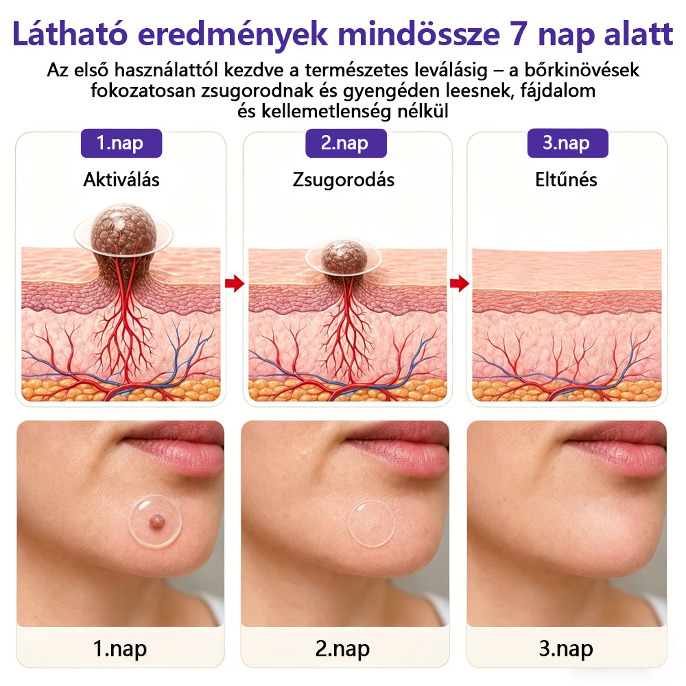 👩🏻‍⚕️COLTURE® szemölcs- és anyajegytávolító mikrotűs tapasz🎁