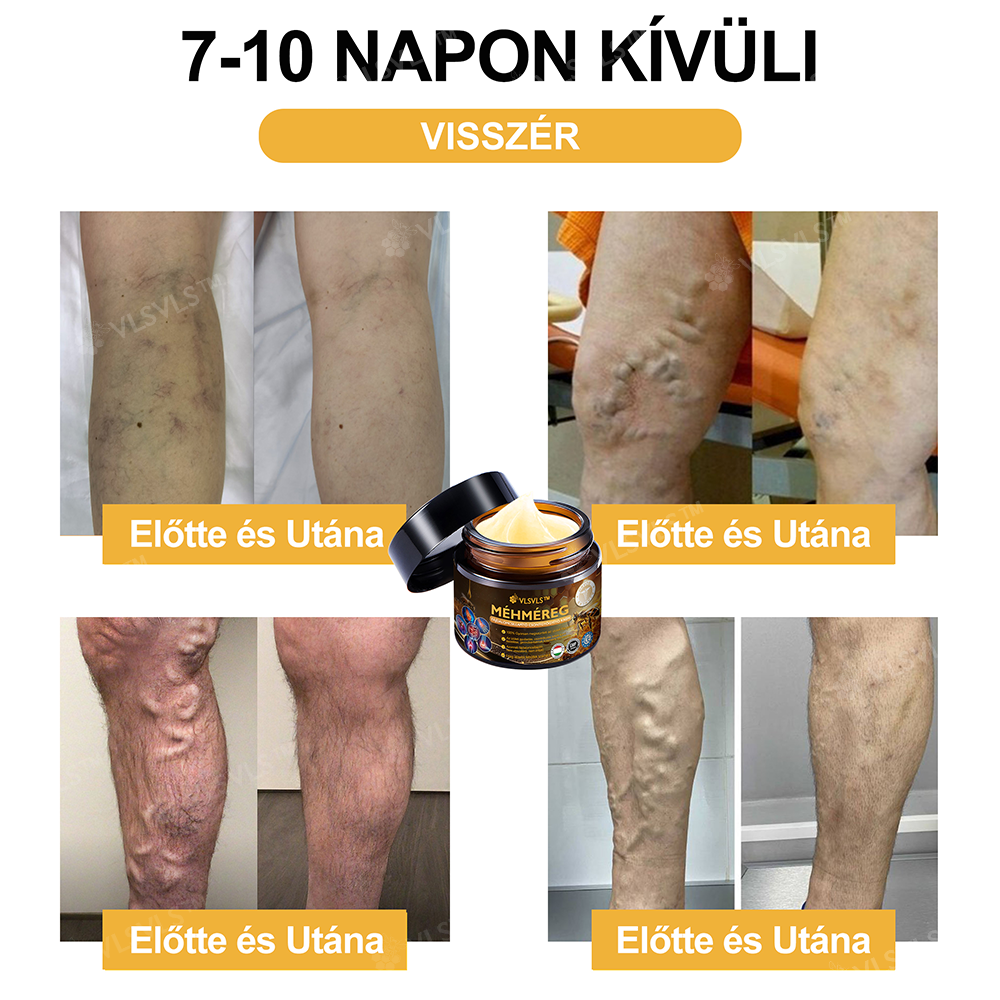 ✨VLSVLS™ Méhméreg Azonnali Ultra Erős Fájdalomcsillapító Krém👍 - (Enyhíti a fájdalmat ízületi gyulladás, izomfájdalom, hátfájás, térdek, hát, vállak, csípők, csuklók, kezek esetén)