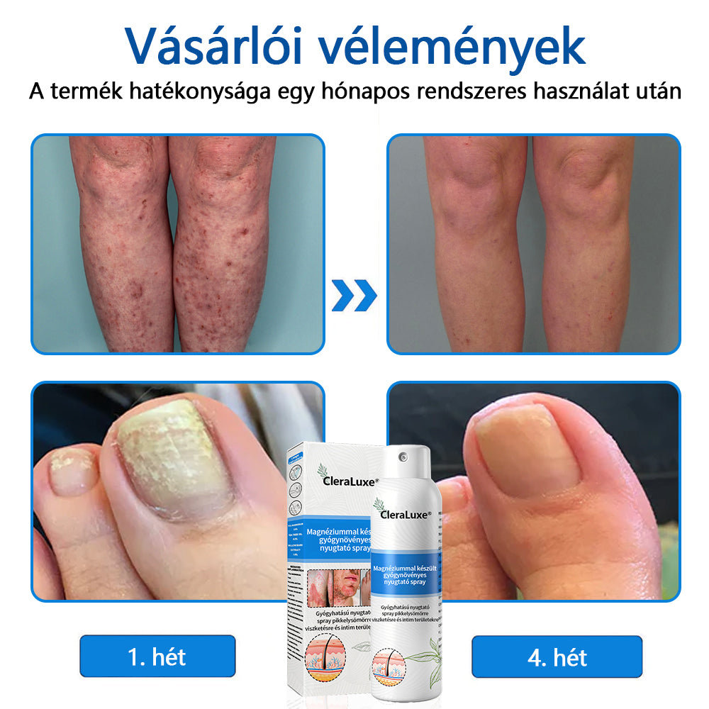 CleraLuxe®  Magnézium Gyógynövényes Pszoriázis Spray💦