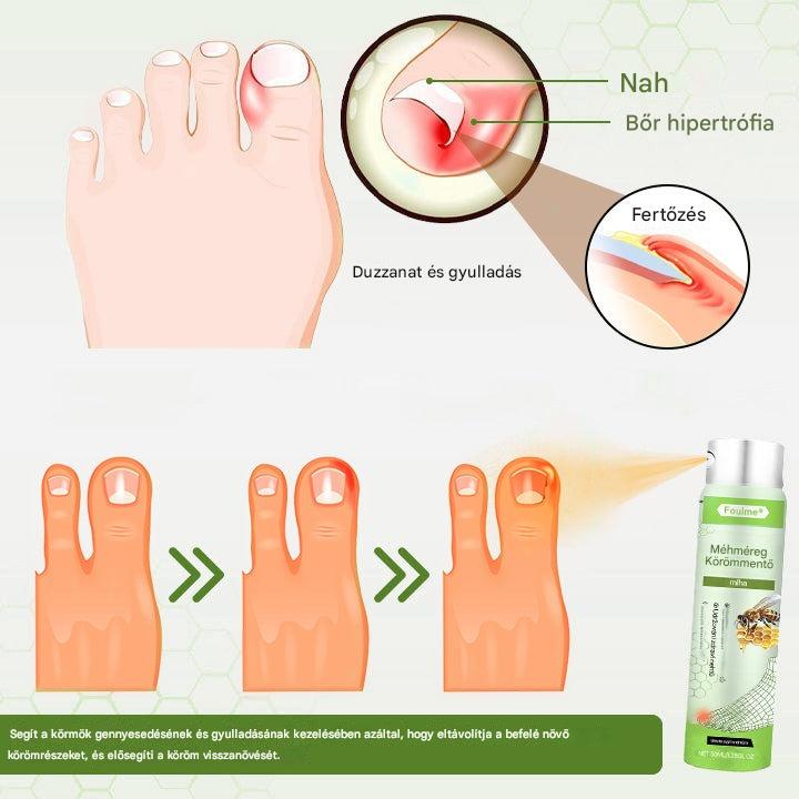 Korlátozott ideig 50%-os kedvezmény | Foulme® NailRescue Méhméreg Spray🎁